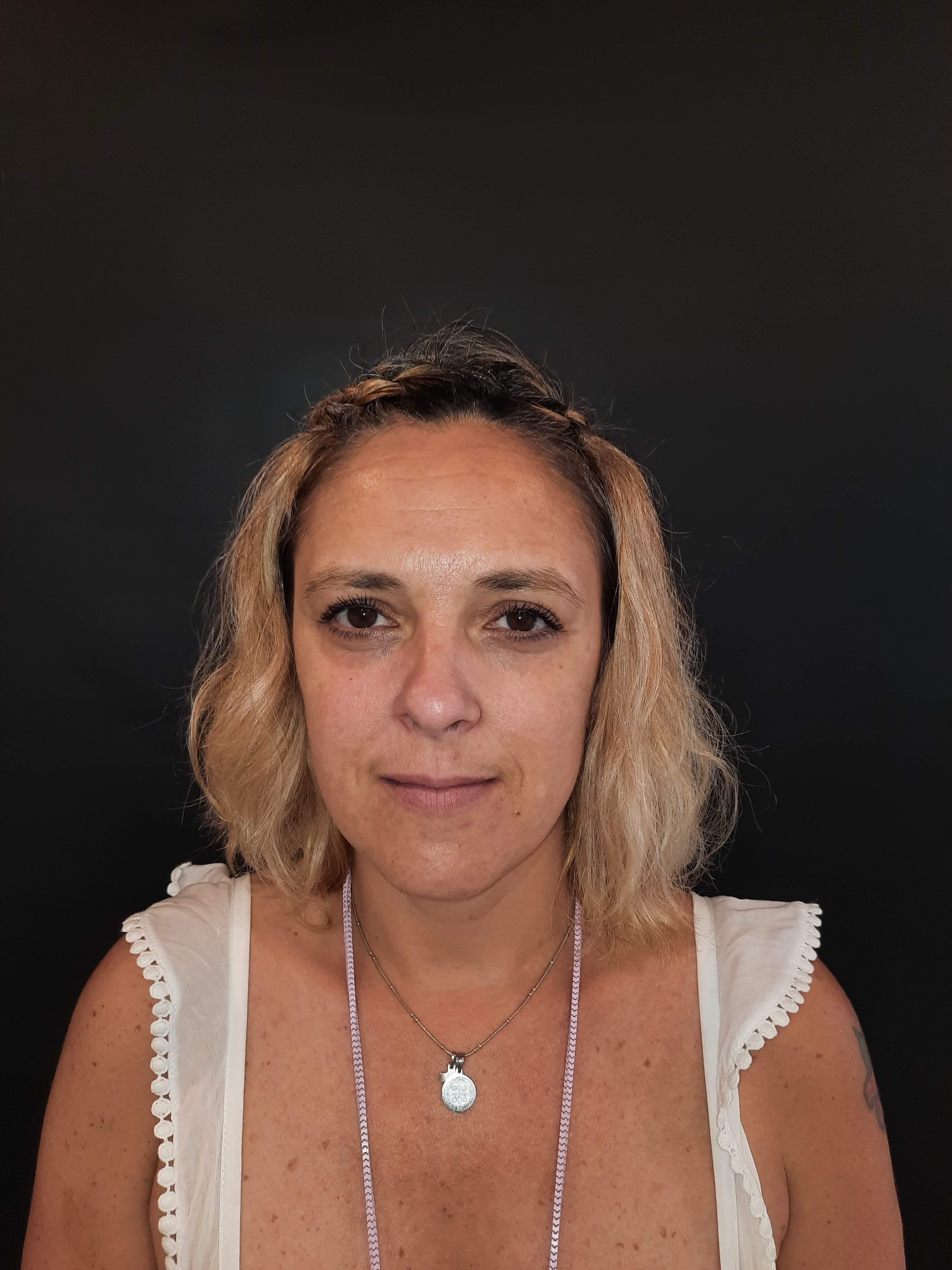 Armonización Facial - antes