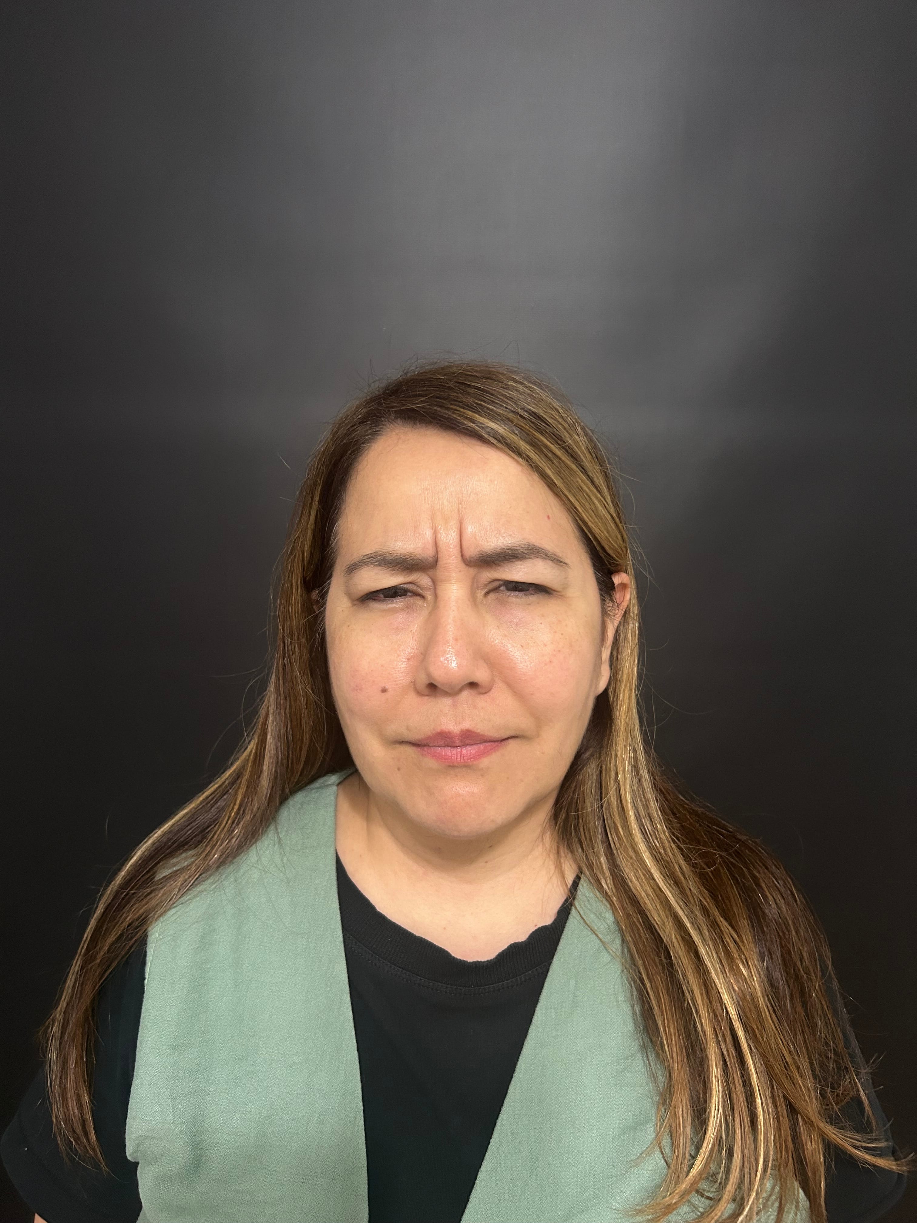 Botox - antes