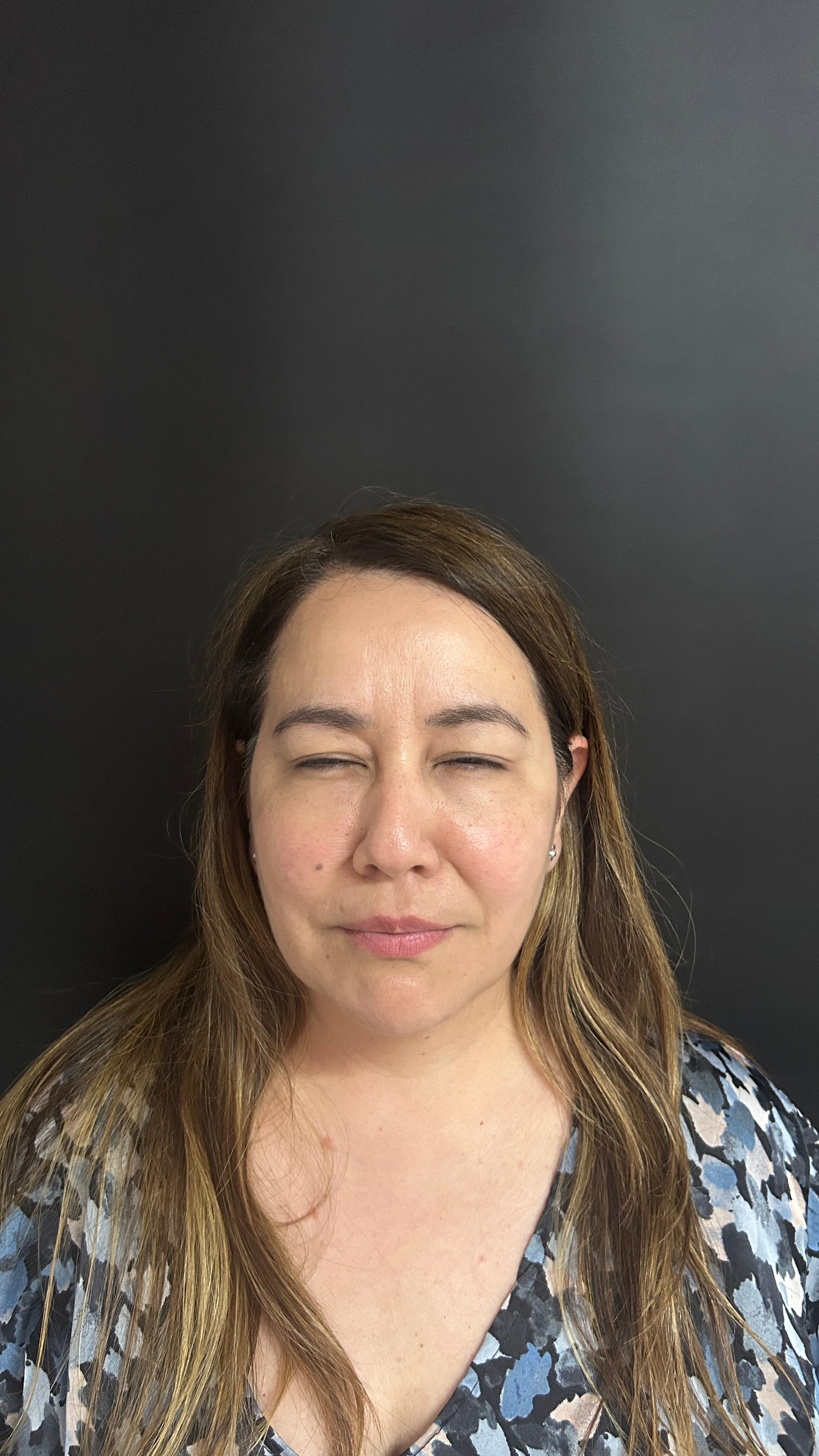 Botox - después