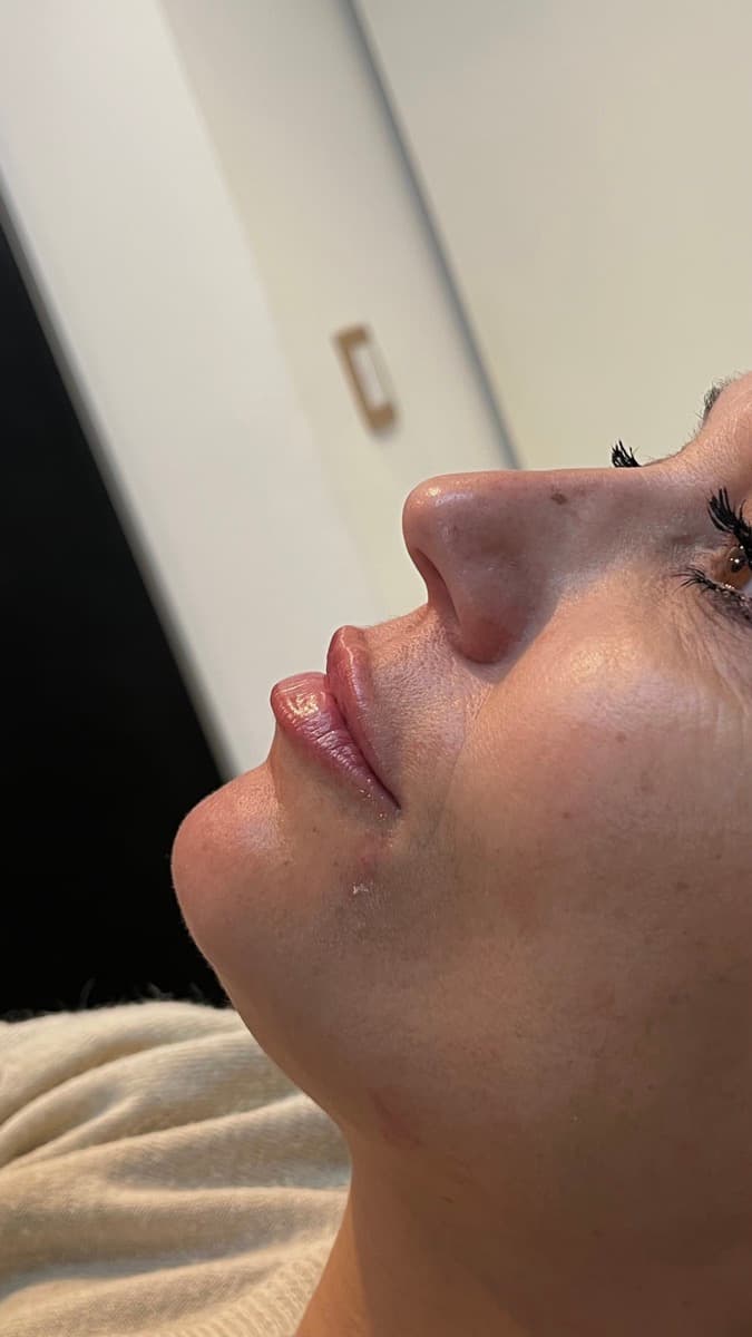 Relleno de Labios